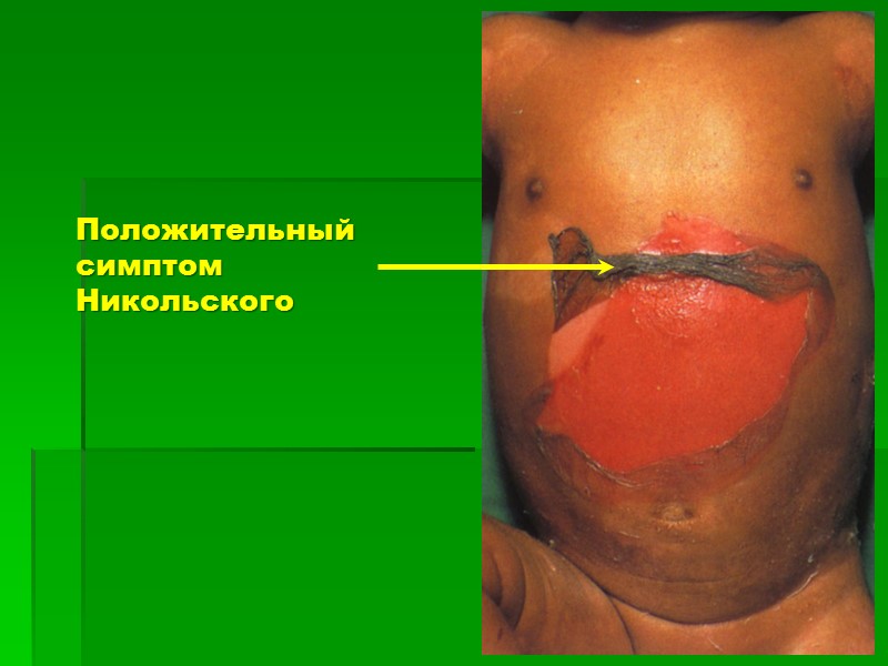 Положительный симптом Никольского
